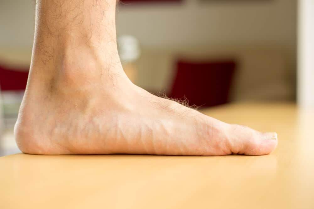 Flat Foot Syndrome