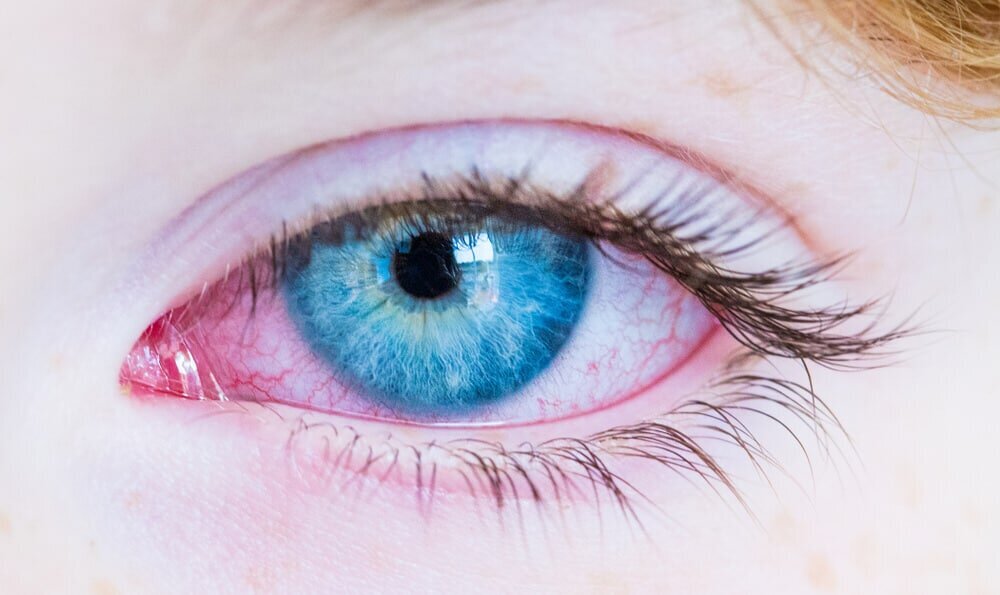 Ozone Therapy and Pink Eye